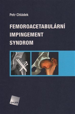 Chládek Petr: Femoroacetabulární impingement syndrom