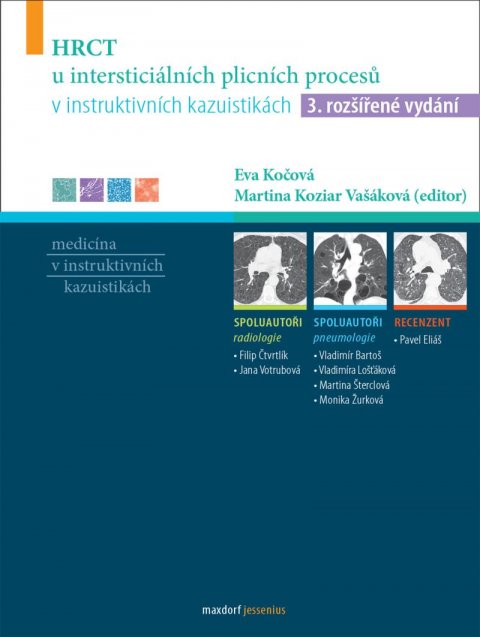 Vašáková Martina: HRCT u intersticiálních plicních procesů v instruktivních kazuistikách