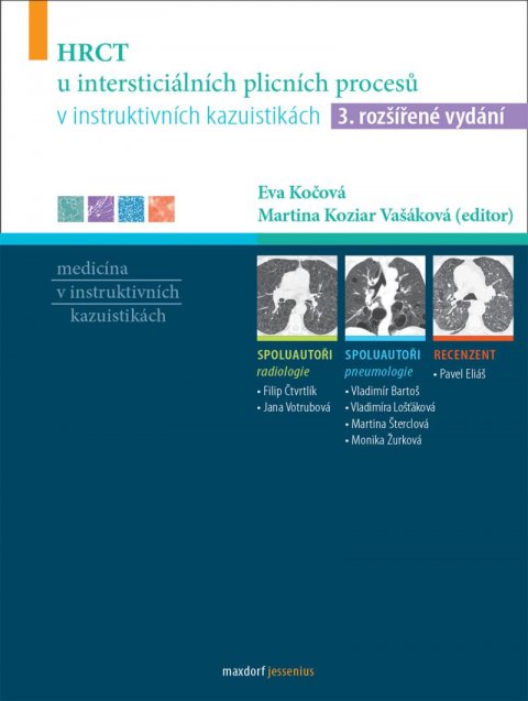 Koziar Vašáková Martina: HRCT u intersticiálních plicních procesů v instruktivních kazuistikách