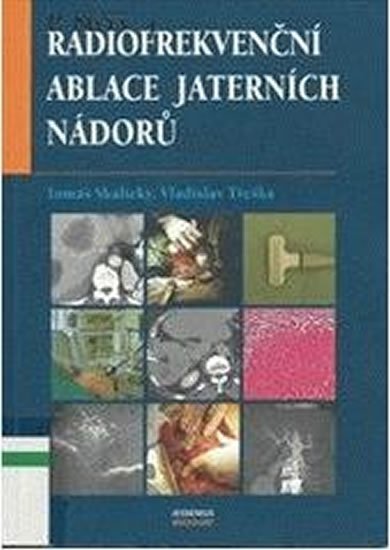 Skalický Tomáš, Třeška Vladislav,: Radiofrekvenční ablace jaterních nádorů Skalický Tomáš, Třeška Vladislav,: Radiofrekvenční ablace jaterních nádorů