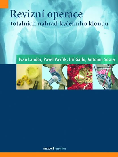 kolektiv autorů: Revizní operace totálních náhrad kyčelního kloubu kolektiv autorů: Revizní operace totálních náhrad kyčelního kloubu
