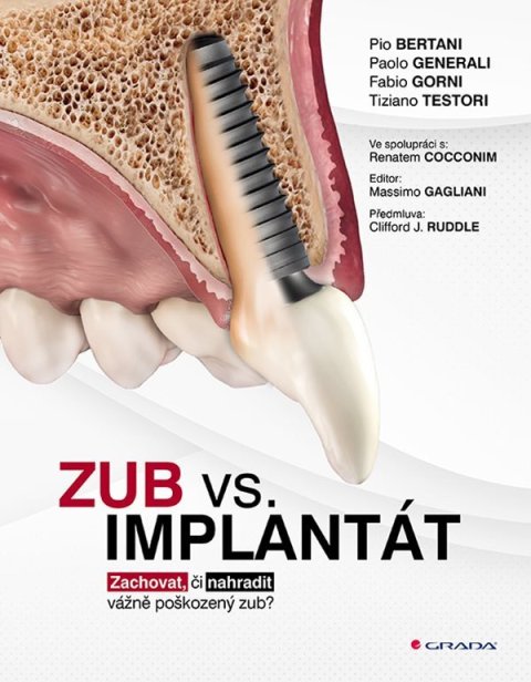 kolektiv autorů: Zub vs. implantát - Zachovat, či nahradit vážně poškozený zub?