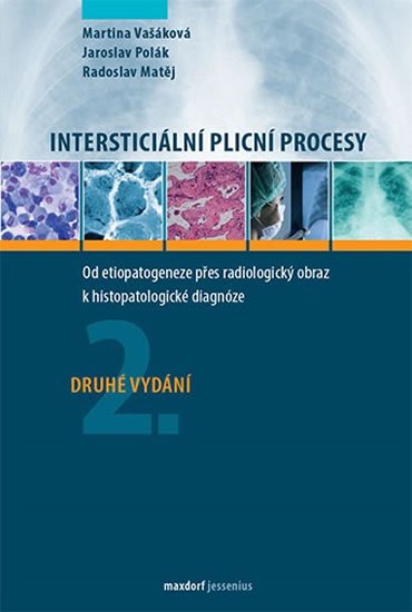 Vašáková Martina, Polák Jaroslav, Matěj Radoslav,: Intersticiální plicní procesy - Od etiopatogeneze přes radiologický obraz k Vašáková Martina, Polák Jaroslav, Matěj Radoslav,: Intersticiální plicní procesy - Od etiopatogeneze přes radiologický obraz k