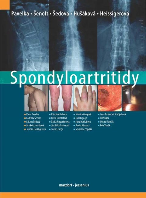 kolektiv autorů: Spondyloartritidy
