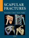Naňka Ondřej: Scapular fractures
