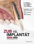kolektiv autorů: Zub vs. implantát - Zachovat, či nahradit vážně poškozený zub?