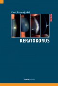 kolektiv autorů: Keratokonus